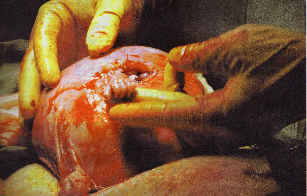 aborted human fetus. Fetal Surgery - Samuel